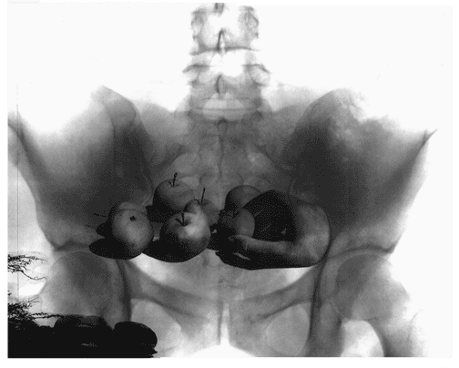 a collage featuring an x-ray of a pelvis with a photograph of apples and hand